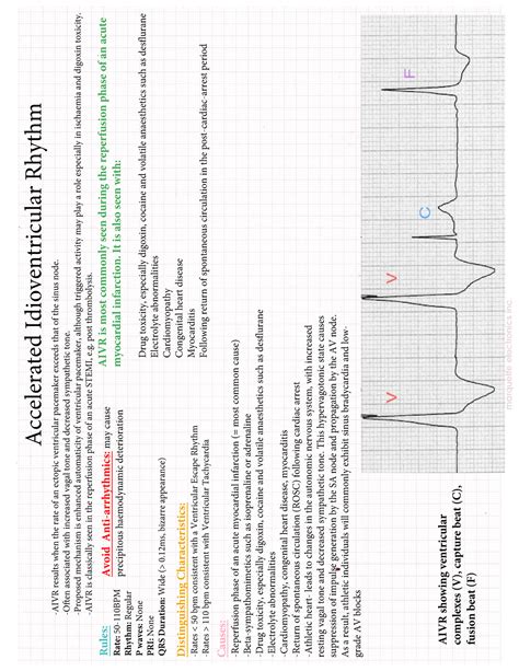 Avir Ekg Information Accelerated Idioventricular Rhythm Aivr