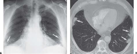 Signs And Patterns Of Lung Disease Radiology Key