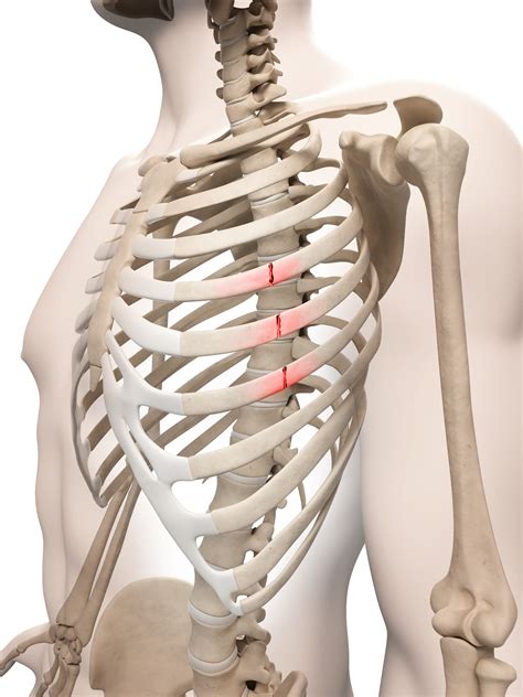 Dealing With Rib Fractures