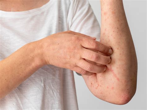 Atopic Dermatitis Health Tips Atopic Dermatitis Health Articles Health News Thehealthsite Com