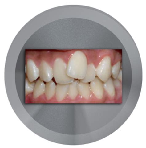 However if the degree of crowding is severe enough, there may be a need to straighten the teeth first through orthodontic treatment before undergoing porcelain veneers. Dental Veneers | Great Aesthetics | Southpointe Dental