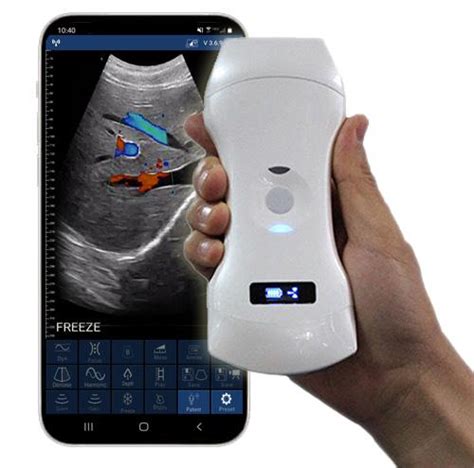 Sonostar Wireless Ultrasound Probe Uprobe C5pl Uds