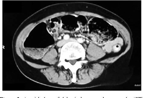 Pdf Report Of An Unusual Case With Severe Fecal Impaction Responding
