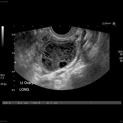 Exploring Sonograms For Ovarian Cysts Understanding The Role Of OB GYN Specialists Coach M Morris