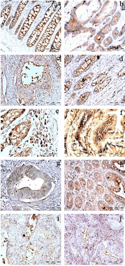 Specific Pattern Of Immunohistochemical Expression Of E Cadherin Mcea