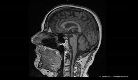 A ct scan (or cat scan) is best suited for viewing bone injuries, diagnosing lung and chest problems, and detecting cancers.an mri is suited for examining soft tissue in ligament and tendon injuries, spinal cord injuries, brain tumors, etc. Approach to MRI brain | LearningNeurology.com
