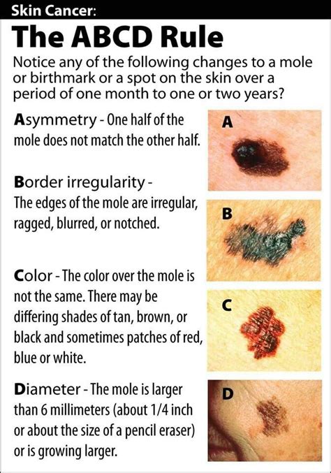 What Are The Abcd Of Skin Cancer Stacey Binders English Worksheets