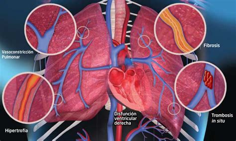 Arteria Pulmonar Anatomia