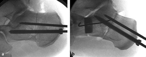 Medializing Calcaneal Osteotomy Musculoskeletal Key