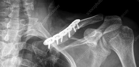Pinned Collar Bone Fracture X Ray Stock Image C0096757 Science