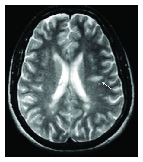 Axial Cerebral T2 Weighted Image Showing Multiple Lesions In