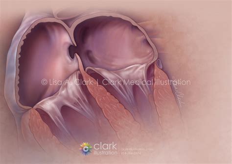Patent Foramen Ovale Pfo Closure Clark Medical Illustration