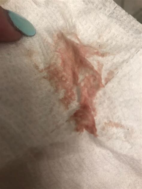 Does This Look Like Implantation Bleeding Or The Start Of A Period