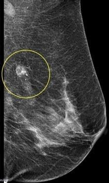 There can be more than one sentinel node. What is the alternative to mamography for diagnosis of ...