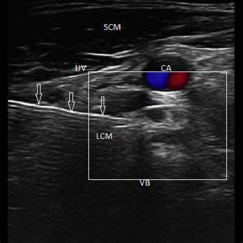 Pdf Ultrasound Guided Left Stellate Ganglion Blocks For Recurrent