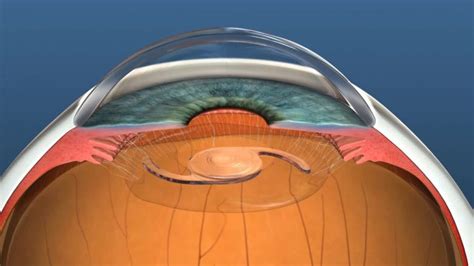 Lens Implant And Replacement William Power Laser Eye Surgery In Dublin