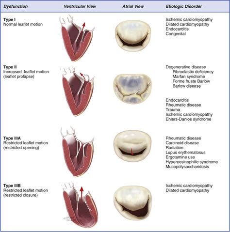 Identification And Quantification Of Degenerative And Functional Mitral