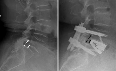 An Example Of A Patient With An Isthmic Spondylolisthesis Who Underwent