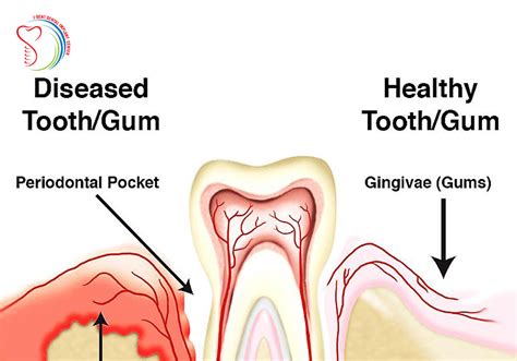 Periodontitis And How To Protect Your Oral Health