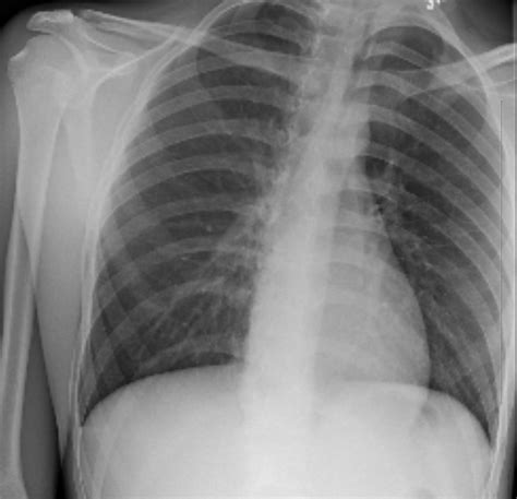 Efficacy determined by receiver operating characteristic. Spontaneous Pneumothorax 3, resolved, XR. JETem 2017 - JETem