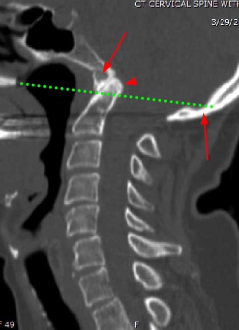 Common Peroneal Nerve Abnormalities Radsource