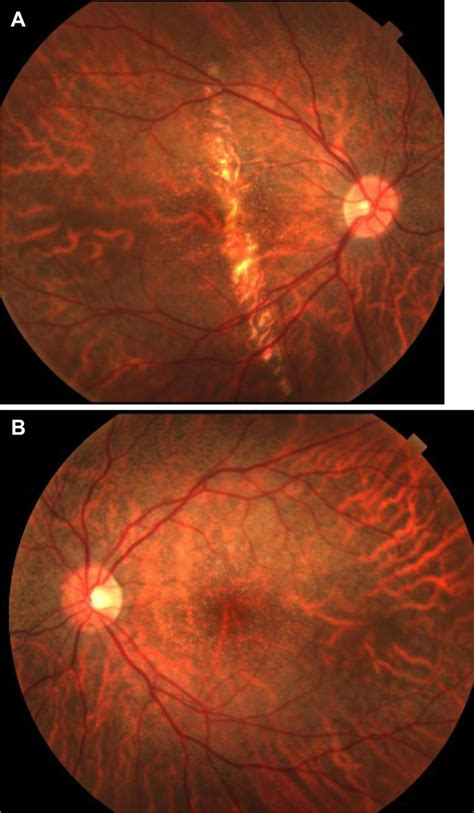 Fundus Photographs Taken 6 Months After Initial Photographs Notes