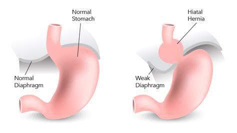 View allall photos tagged hiatalhernia. Hiatal Hernia Repair at TLC Houston's Heartburn Center