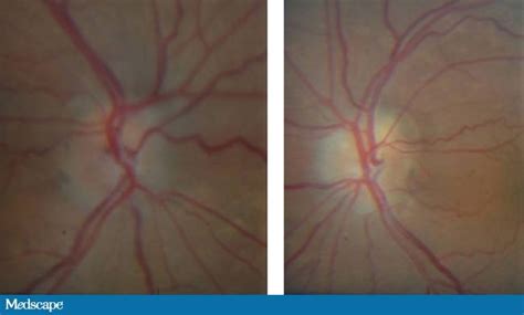 A 51 Year Old Woman With Blurred Optic Disc Margins
