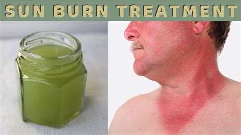 Natural Sun Burn Remedy To Instantly Stop Pain And Prevent Peeling Fast