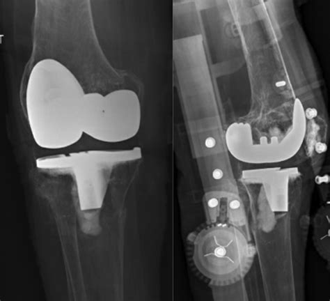 Periprosthetic Knee Fractures Musculoskeletal Key