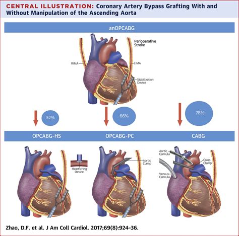 Coronary Artery Bypass Grafting With And Without Manipulation Of The
