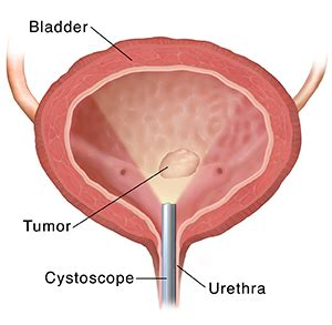 A cystoscopy is a procedure to look inside the bladder using a thin camera called a cystoscope. Treating Bladder Cancer: Transurethral Resection (TUR ...