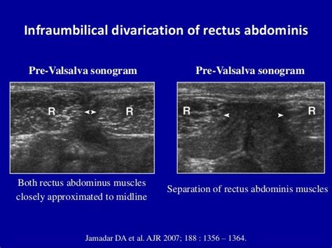 Ultrasound Of The Abdominal Wall Hernias