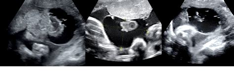 Figure 2 From Prenatal Diagnosis Of Multiple Large Subchorionic