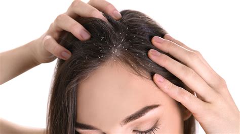 How To Tell If You Have Scalp Psoriasis Vs Dandruff