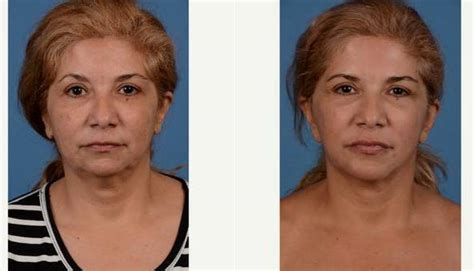 51 Year Old Woman Treated With Facelift Neck Lift Upper And Lower