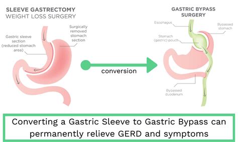 Hiatal Hernia After Gastric Bypass What It Is Complications Options