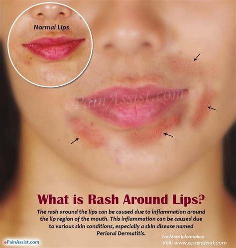 Best Of How To Get Rid Of Heat Rash Around Lips And View In 2020 Dry