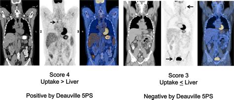 Interim 18f Fdg Pet In Hodgkin Lymphoma Would Pet Adapted Clinical