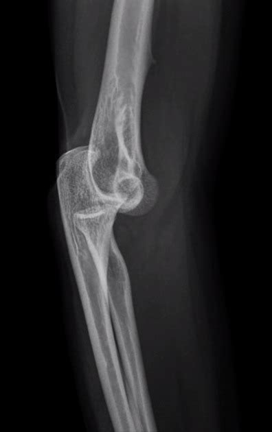 Elbow Dislocation Pacs