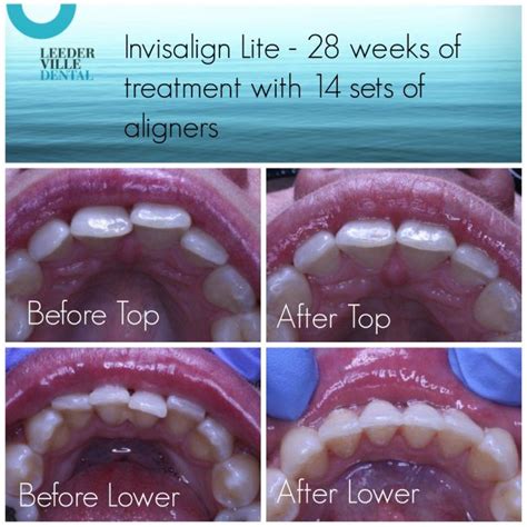 Invisalign Lite Before And After Leederville Dental Perths Most