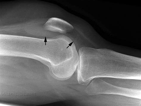 Soft Tissue Signs Knee Trauma Wikiradiography