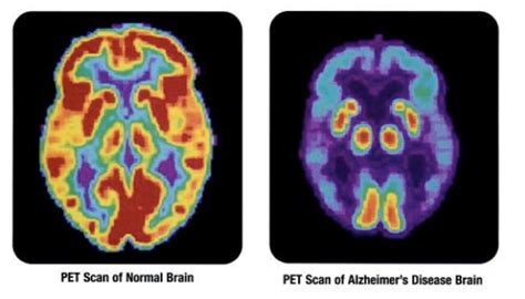 Pet Scans Detect Early Signs Of Alzheimers Specialty Teleradiology Inc