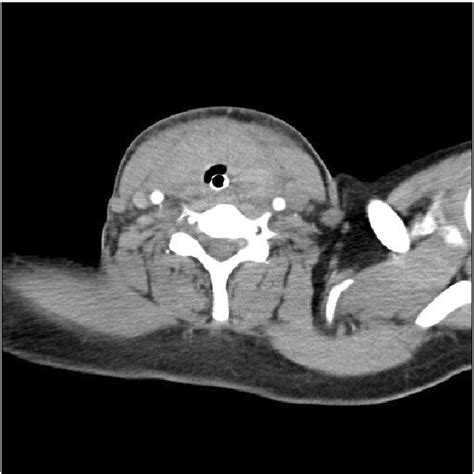 Neck Angio Computed Tomography Ct Scan Of Our Patient It Showed A