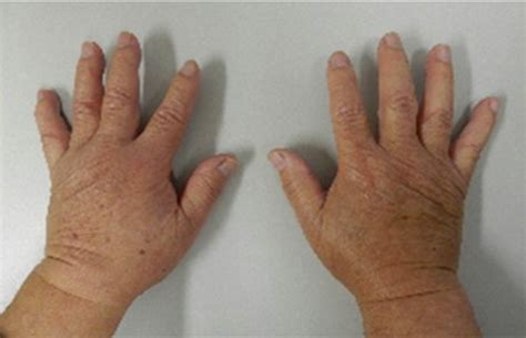 Pitting Edema Of Hands In Patient With Arthralgia Download
