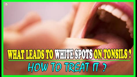 What Causes White Spots On The Tonsils And How To Treat It Best Home