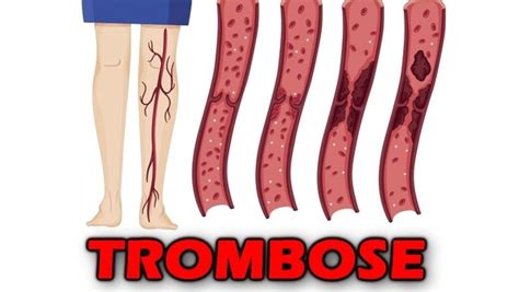 Trombose is een ernstige bloedsomloopstoornis die wordt veroorzaakt doordat een bloedstolsel de bloedstroom in een ader (veneuze trombose) of een slagader (arteriële trombose) blokkeert. Trombose, o que é? Sintomas e tratamento! - Buscar Saúde