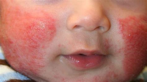 5 Common Skin Conditionsrashes In Babieschildren Kids Clinic 2022