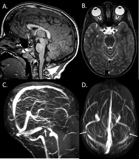 Magnetic Resonance Imaging Findings In Pediatric Pseudotumor Cerebri Syndrome Pediatric Neurology