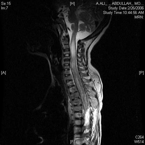 Mri Anatomy Of Spine